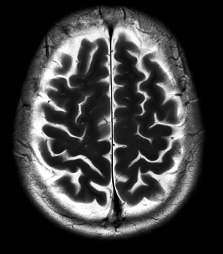 Vertex Registration | decorative image of a brain 